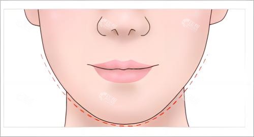 下巴提升后正面示例图