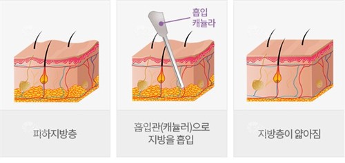 皮下脂肪层抽脂后对比图