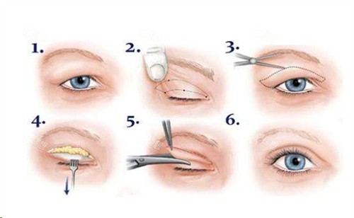 全切双眼皮手术流程卡通示例图