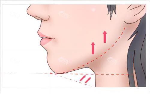 下巴提升术后示例图