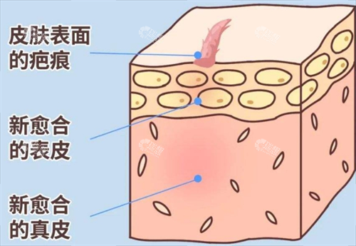 疤痕素材