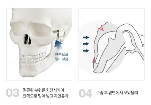 缩小颧骨颧弓手术示例图