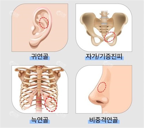 隆鼻材料示例图